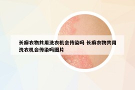 长癣衣物共用洗衣机会传染吗 长癣衣物共用洗衣机会传染吗图片