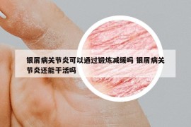 银屑病关节炎可以通过锻炼减缓吗 银屑病关节炎还能干活吗