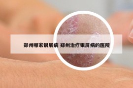郑州哪家银屑病 郑州治疗银屑病的医院