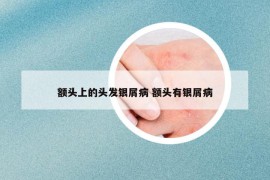 额头上的头发银屑病 额头有银屑病