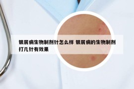 银屑病生物制剂针怎么样 银屑病的生物制剂打几针有效果