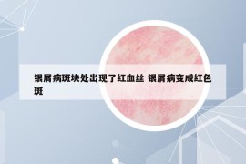 银屑病斑块处出现了红血丝 银屑病变成红色斑