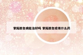 掌跖脓包病能治好吗 掌跖脓包症用什么药