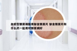 血瘀型银屑病服用郁金银屑片 郁金银屑片和什么药一起用对银屑病好
