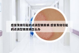 感冒发烧引起的点滴型银屑病 感冒发烧引起的点滴型银屑病怎么办