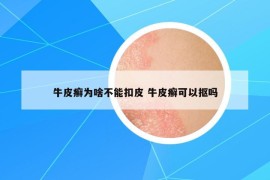 牛皮癣为啥不能扣皮 牛皮癣可以抠吗