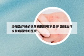 洛阳治疗好的银屑病医院哪家最好 洛阳治疗皮肤病最好的医院