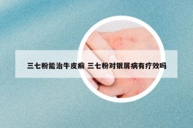 三七粉能治牛皮癣 三七粉对银屑病有疗效吗