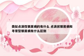 类似点滴性银屑病的有什么 点滴状银屑病和寻常型银屑病有什么区别