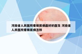 河南省人民医院看银屑病最好的医生 河南省人民医院看银屑病怎样