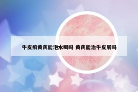 牛皮癣黄芪能泡水喝吗 黄芪能治牛皮屑吗