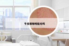 牛皮癣咖啡能吃吗