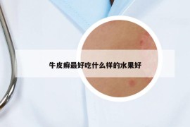 牛皮癣最好吃什么样的水果好