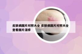 皮肤病图片对照大全 皮肤病图片对照大全 查看图片湿疹