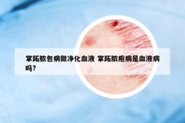 掌跖脓包病做净化血液 掌跖脓疱病是血液病吗?