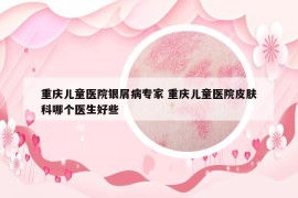 重庆儿童医院银屑病专家 重庆儿童医院皮肤科哪个医生好些