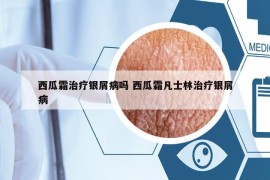 西瓜霜治疗银屑病吗 西瓜霜凡士林治疗银屑病