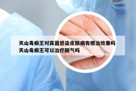 天山毒癣王对真菌感染皮肤病有根治效果吗 天山毒癣王可以治疗脚气吗