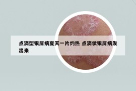 点滴型银屑病夏天一片灼热 点滴状银屑病发出来