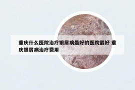 重庆什么医院治疗银屑病最好的医院最好 重庆银屑病治疗费用
