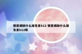 银屑病缺什么维生素b12 银屑病缺什么维生素b12呢