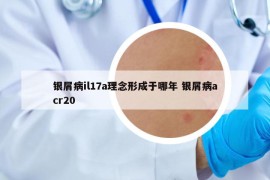 银屑病il17a理念形成于哪年 银屑病acr20