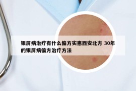 银屑病治疗有什么偏方实惠西安北方 30年的银屑病偏方治疗方法