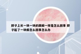 脖子上长一块一块的跟癣一样是怎么回事 脖子起了一块癣怎么回事怎么办