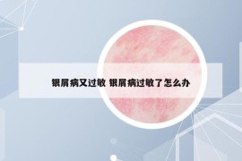 银屑病又过敏 银屑病过敏了怎么办