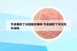 牛皮癣好了以后能吃辣吗 牛皮癣好了可以吃牛肉吗