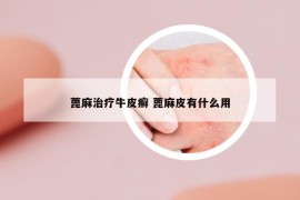 蓖麻治疗牛皮癣 蓖麻皮有什么用