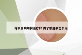 得银屑病如何治疗好 得了银屑病怎么治