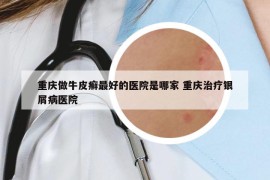 重庆做牛皮癣最好的医院是哪家 重庆治疗银屑病医院