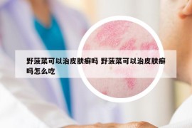 野菠菜可以治皮肤癣吗 野菠菜可以治皮肤癣吗怎么吃