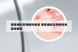 银屑病的生物制剂来源 银屑病的生物制剂来源有哪些