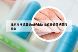 北京治疗银屑病的好去处 北京治银屑病医院排名