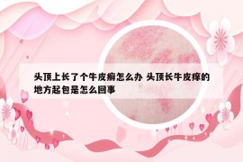 头顶上长了个牛皮癣怎么办 头顶长牛皮痒的地方起包是怎么回事