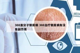 308准分子银屑病 308治疗银屑病有没有副作用
