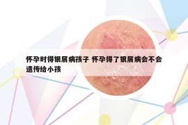 怀孕时得银屑病孩子 怀孕得了银屑病会不会遗传给小孩