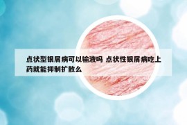 点状型银屑病可以输液吗 点状性银屑病吃上药就能抑制扩散么