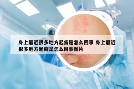 身上最近很多地方起癣是怎么回事 身上最近很多地方起癣是怎么回事图片