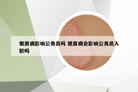 银屑病影响公务员吗 银屑病会影响公务员入职吗