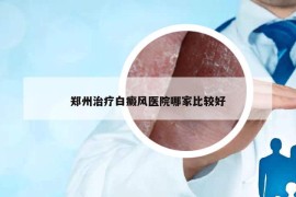 郑州治疗白癜风医院哪家比较好