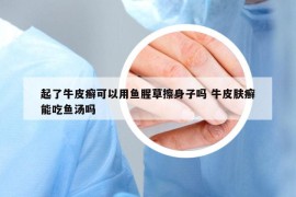 起了牛皮癣可以用鱼腥草擦身子吗 牛皮肤癣能吃鱼汤吗