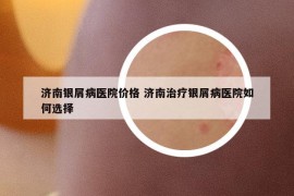 济南银屑病医院价格 济南治疗银屑病医院如何选择