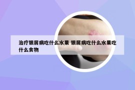 治疗银屑病吃什么水果 银屑病吃什么水果吃什么食物