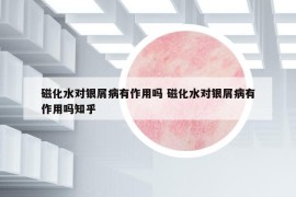 磁化水对银屑病有作用吗 磁化水对银屑病有作用吗知乎