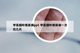 甲氨蝶呤银屑病ppt 甲氨蝶呤银屑病一次吃几片