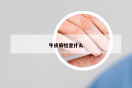 牛皮癣检查什么