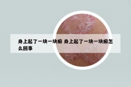 身上起了一块一块癣 身上起了一块一块癣怎么回事